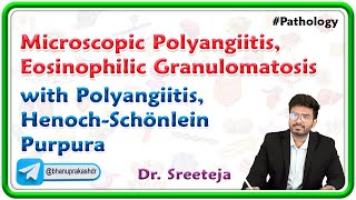 3 Microscopic Polyangiitis Eosinophilic Granulomatosis with Polyangiitis HenochSchönlein Purpura [upl. by Couture]