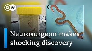 Neurosurgeon removes live worm from womans brain in worldfirst discovery  DW News [upl. by Isewk300]