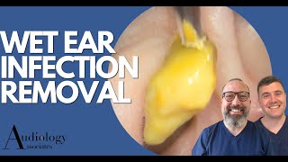 EAR INFECTION REMOVAL EP870 [upl. by Solrak957]