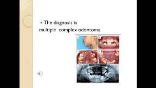 Complex Odontoma [upl. by Elle690]