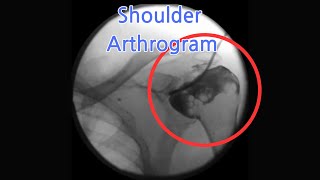 Shoulder Arthrogram A Comprehensive Guide to Diagnosing Shoulder Injuries 어깨 관절 조영어깨 손상 진단을 위한 가이드 [upl. by Emmuela]