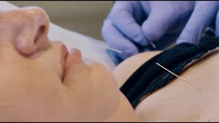 How Does ACUPUNCTURE Work Acupuncture Treatment For Back Pain Headaches amp More [upl. by Ennasirk]