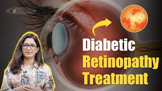 Diabetic Retinopathy Treatment  Diabetic Retinopathy Symptoms Diagnosis Prevention amp Treatment [upl. by Dirrej]