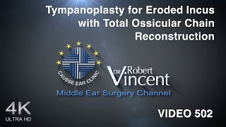 Tympanoplasty for Eroded Incus with Total Ossicular Chain Reconstruction [upl. by Cleland82]