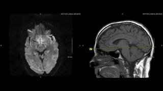 Unremarkable NonContrast Brain MRI Axial DWI Coefficient b1000 Example 1 [upl. by Shawn]