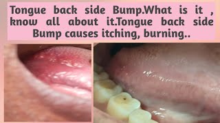 Tongue back side BumpWhat is it  know all about itTongue back side Bump causes itching burning [upl. by Amle]