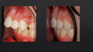 8mm Overjet Correction Orthodontics [upl. by Shanie]