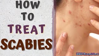 HOW TO TREAT SCABIESscabies treatment at home [upl. by Sul680]