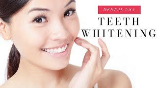 2 hour teeth whitening [upl. by Enetsirk]