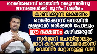 വെരിക്കോസ് വെയിൻ ഉള്ളവർ ഒരിക്കൽ പോലും ഈ ഭക്ഷണം കഴിക്കരുത്  Varicose veins Malayalam [upl. by Ebeneser988]