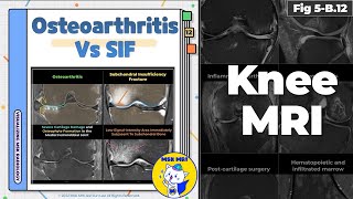 Fig 5B12 Osteoarthritis vs Subchondral Insufficiency Fracture [upl. by Ybur227]