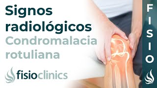 Condromalacia rotuliana Signos radiológicos  FisioClinics Palma de Mallorca [upl. by Niggem]