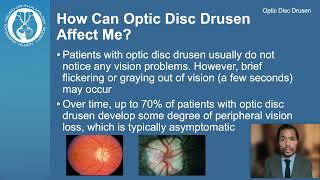 Optic Disc Drusen [upl. by Adina]