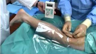 Continuous Popliteal Nerve Block [upl. by Yniar948]