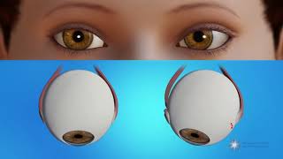 How is strabismus surgery done [upl. by Anyahc]