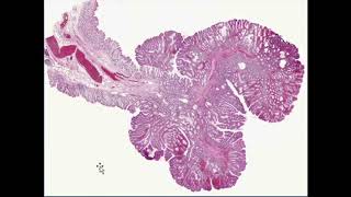 neoplasia robbins pathology full review with combined and enhanced quality [upl. by Margaret480]