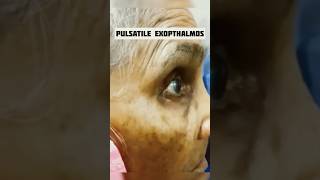 Pulsatile Exophthalmos [upl. by Asin]