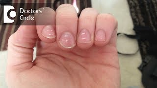 What causes white spots on nails and how to manage them  Dr Amee Daxini [upl. by Zales]