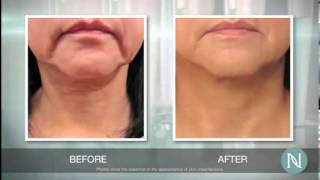 Eliminate Enlarged Pores  How To Reduce Pore Size Quickly  Watch This [upl. by Aretta]