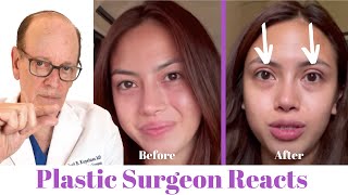 Getting Eyelid Surgery Blepharoplasty  Plastic Surgeon Reacts [upl. by Ahsiekit]