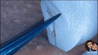 Ingrown Hair Removal Ep28 [upl. by Flann]