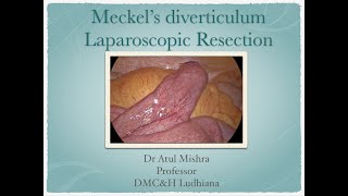 Meckels Diverticulum Laparoscopic resection  Dr Atul Mishra Ludhiana [upl. by Noreen264]