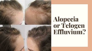 Alopecia or Telogen Effluvium [upl. by Aiclid]