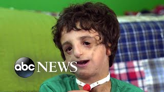 Boy living with Treacher Collins has 53 surgeries by age 11 2020 Part 2 [upl. by Eeb]