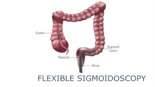 What its like to have a flexible sigmoidoscopy  Cancer Research UK 2021 [upl. by Dnomad]