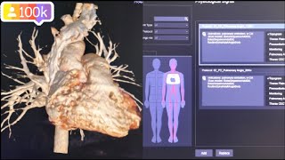 pulmonary angiography  ct pulmonary angiography procedures in Hindi [upl. by Haldas]