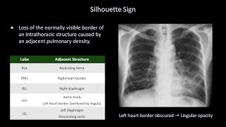 How to Interpret a Chest XRay Lesson 8  Focal Lung Processes [upl. by Erapsag]