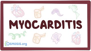 Myocarditis  causes symptoms diagnosis treatment pathology [upl. by Letsyrk723]