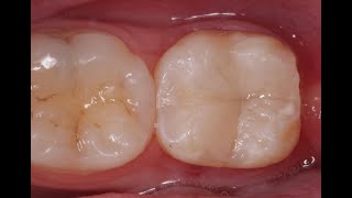 Endo and Direct Composite Restoration [upl. by Ketchum]