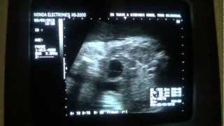 CYST with echogenic area in FETAL lower abdomen [upl. by Hayimas]