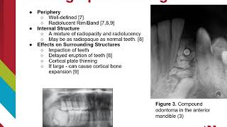 Odontoma [upl. by Beth]