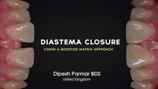 Diastema Closure Renamel with Dipesh Parmar [upl. by Aikemal625]