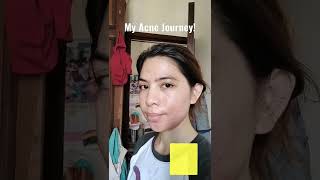 Paano nawala ang pimples ko Watch my latest vlog [upl. by Eilla]