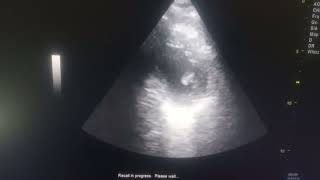 HYPOKINESIA OF ANTERO SEPTUM APICAL SEPTUM APEX AND ANTEROLATERAL MODERATE LV [upl. by Novart891]