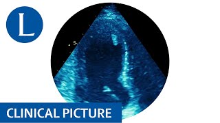 Takotsubo cardiomyopathy in a patient with Lynch syndrome [upl. by Robinia]