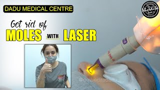 Laser Mole Removal  Get rid of moles with laser  Procedure Video [upl. by Lowndes38]