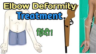 elbow deformity treatment  elbow deformity correction exercises  cubitous valgus correction [upl. by Asilet994]