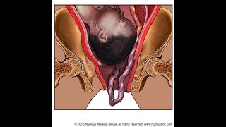 Umbilical Cord Prolapse [upl. by Miah]