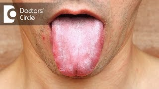 Is Oral Candidiasis related to HIV status  Dr Mohammed Fayaz Pasha [upl. by Antonia620]