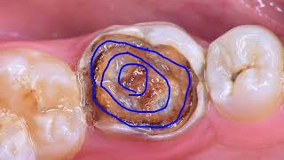 Biomimetic  Caries Removal EndPoint  مدرسة البايوممتك  ازالة التسوس [upl. by Kendricks600]