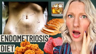 The Truth About The Endometriosis Diet This is your warning sign [upl. by Dionis675]