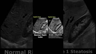 Fatty Liver Grading On Ultrasound  Hepatic Steatosis Grades 123  Normal Vs Abnormal USG shorts [upl. by Flanders]