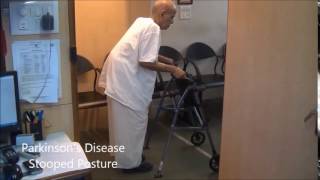 Stooped Posture in Parkinsons Disease  Dr Paresh Doshi [upl. by Crosby]