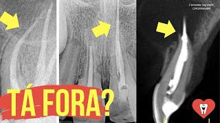 ENDODONTIA COM CONE PASSANDO É ISSO QUE PODE ACONTECER  Endolovers [upl. by Ferrick859]