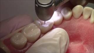 Tutorial on Class I Cavity Preparation Amalgam Restoration  DENTALKART [upl. by Ayiak730]