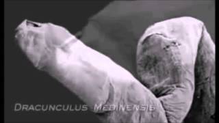 Dracunculus medinensis Parasitology Video [upl. by Loggins]